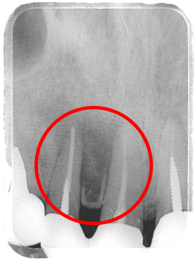 根管治療症例
